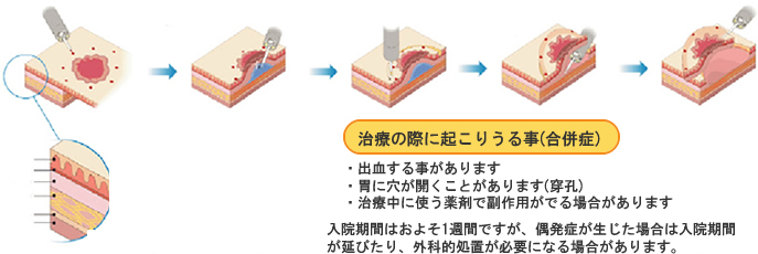 ESDの手順