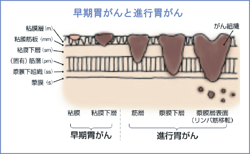 早期胃がんと進行胃がん