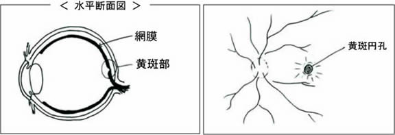 黄斑円孔手術