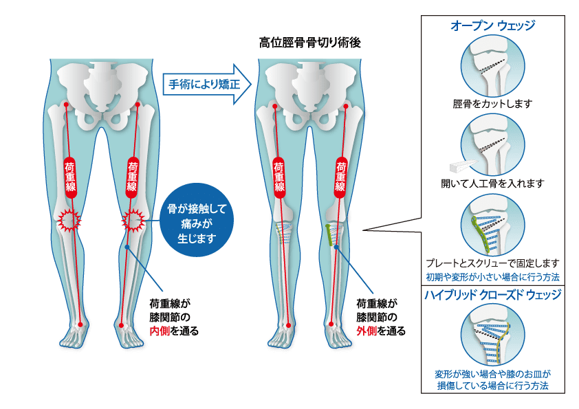 術前と術後のイメージ図