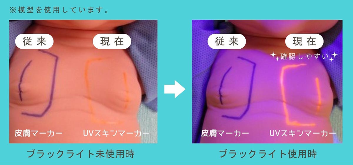 UVスキンマーカー