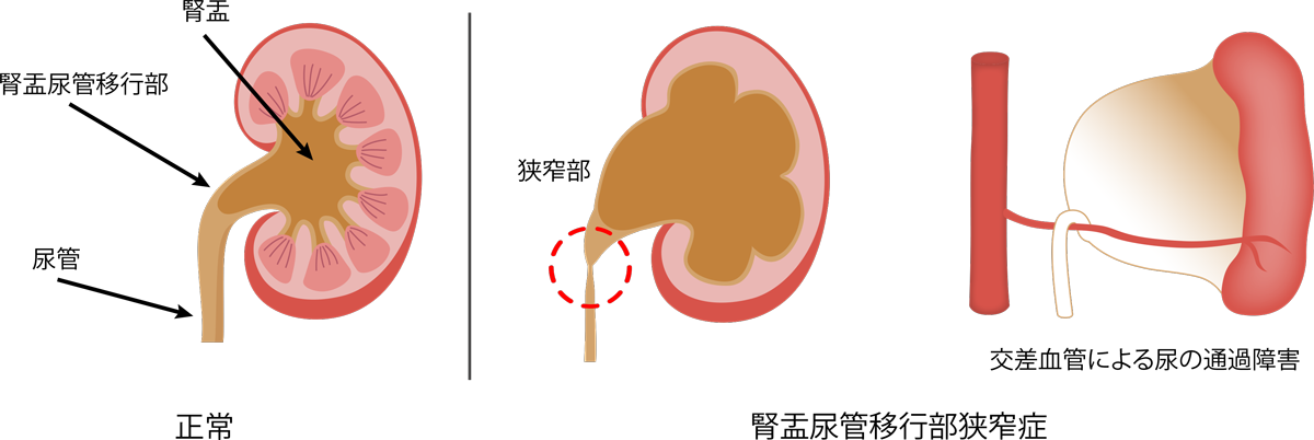 腎臓結石の通過にはどのくらい時間がかかりますか?