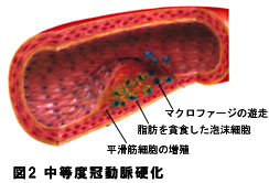 中等度冠動脈硬化