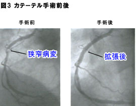 カテーテル前後