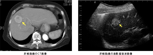 肝細胞癌のCT画像、肝細胞癌の造影超音波