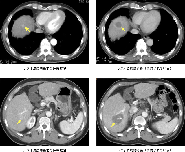ラジオ波焼灼術前の肝細胞癌、ラジオ波焼灼術後（焼灼されている）、ラジオ波焼灼術前の肝細胞癌、ラジオ波焼灼術後（焼灼されている）