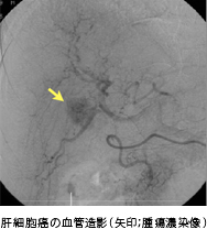 肝細胞癌の血管造影（矢印；腫瘍濃染像）