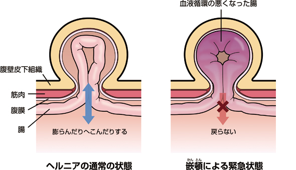 ヘルニア2